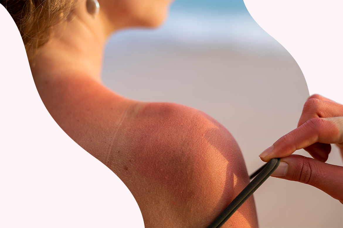 Después del sol: cómo calmar la piel enrojecida o sensibilizada