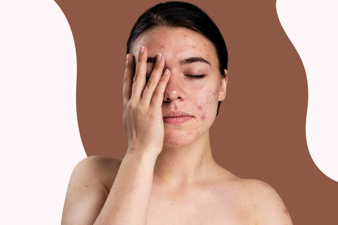 Manchas en la piel, ¿qué las causa y cómo prevenir su aparición?